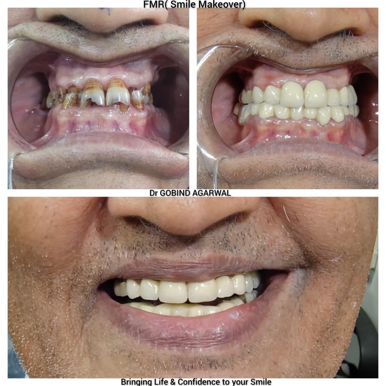 FMR Smile Makeover Before After - Dr Gobind Agarwal Kankurgachi Kolkata