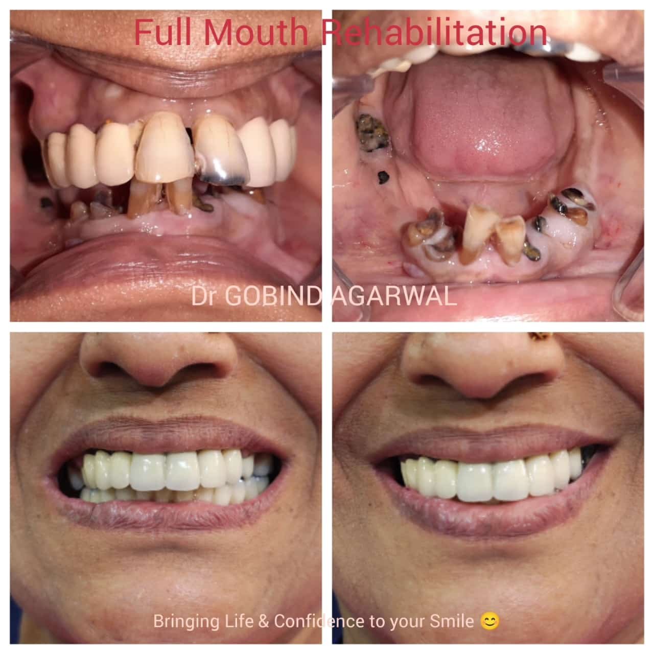 Full Mouth Rehabilitation with Dental Implants - Dr Gobind Agarwal Kankurgachi Kolkata