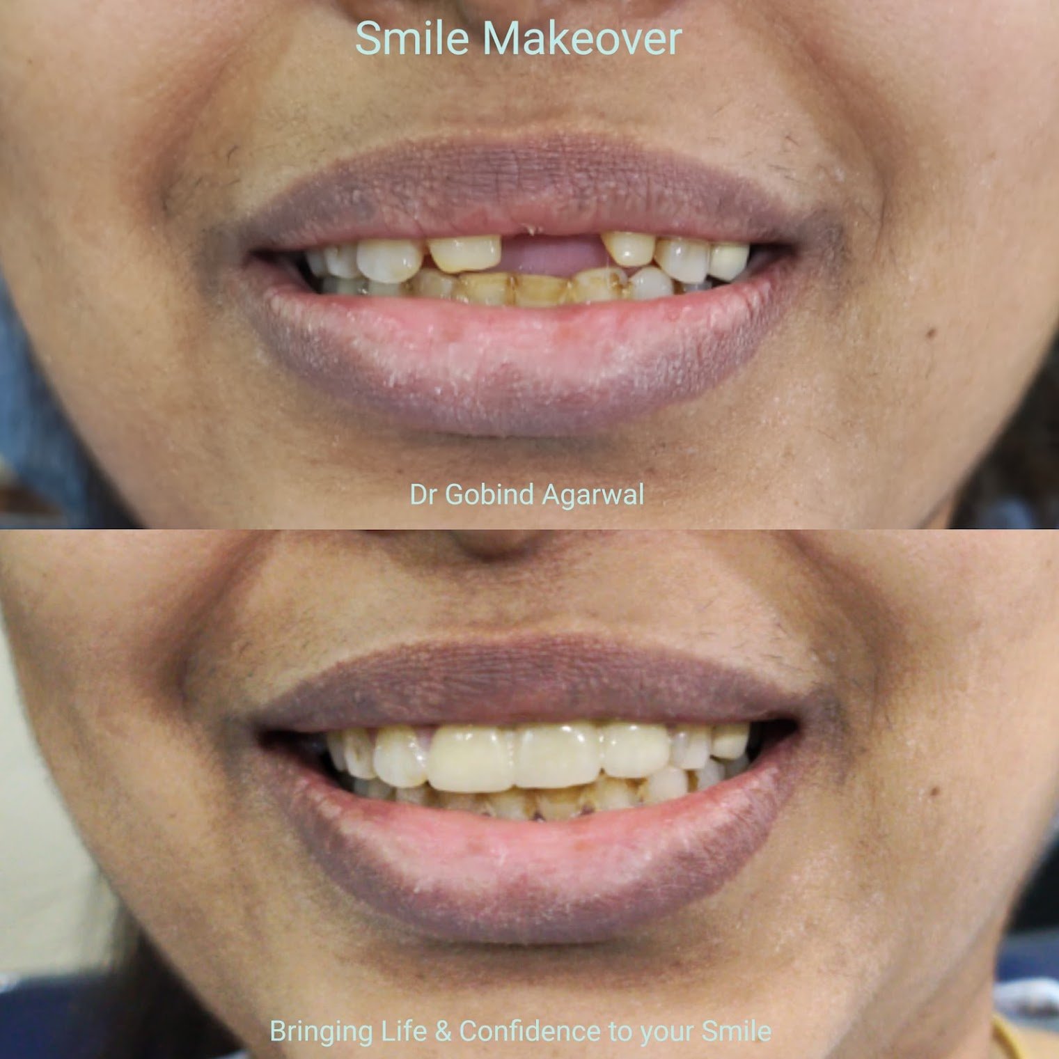 Smile Makeover with Veneers Before After - Dr Gobind Agarwal Kankurgachi Kolkata